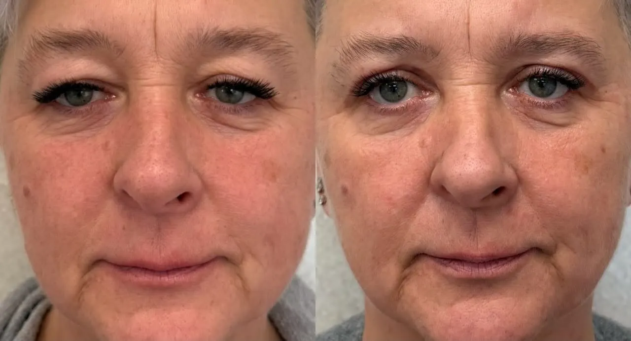Przed i po: Blefaroplastyka powiek